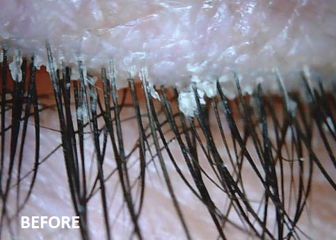 Eyelashes Before Use BlephEx