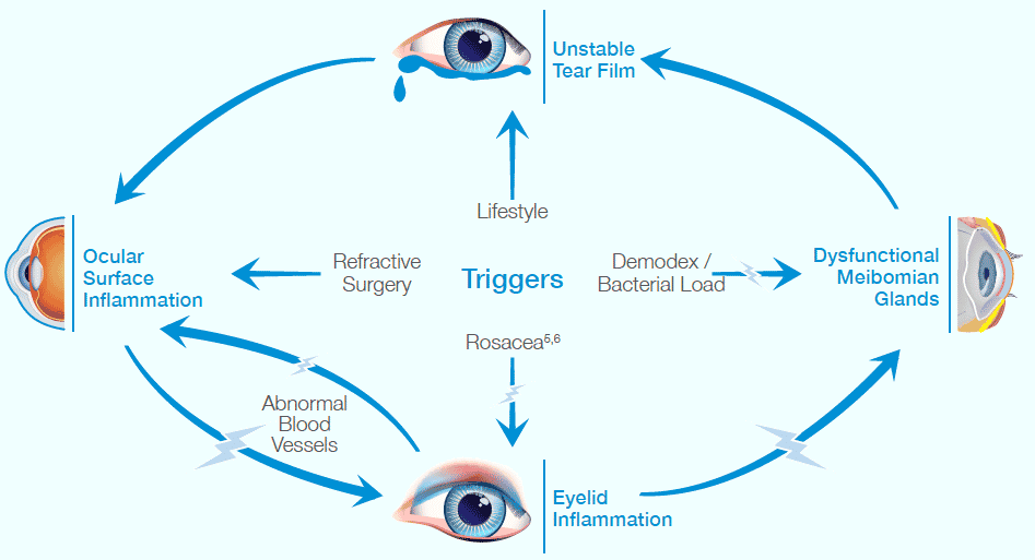 Dry Eye Disease Treatment In Cyprus